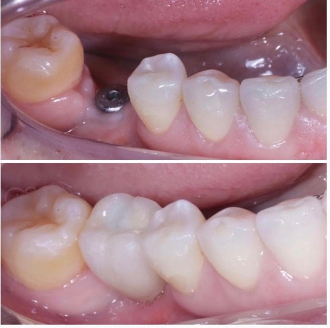 Transformação 4 — implante dentário