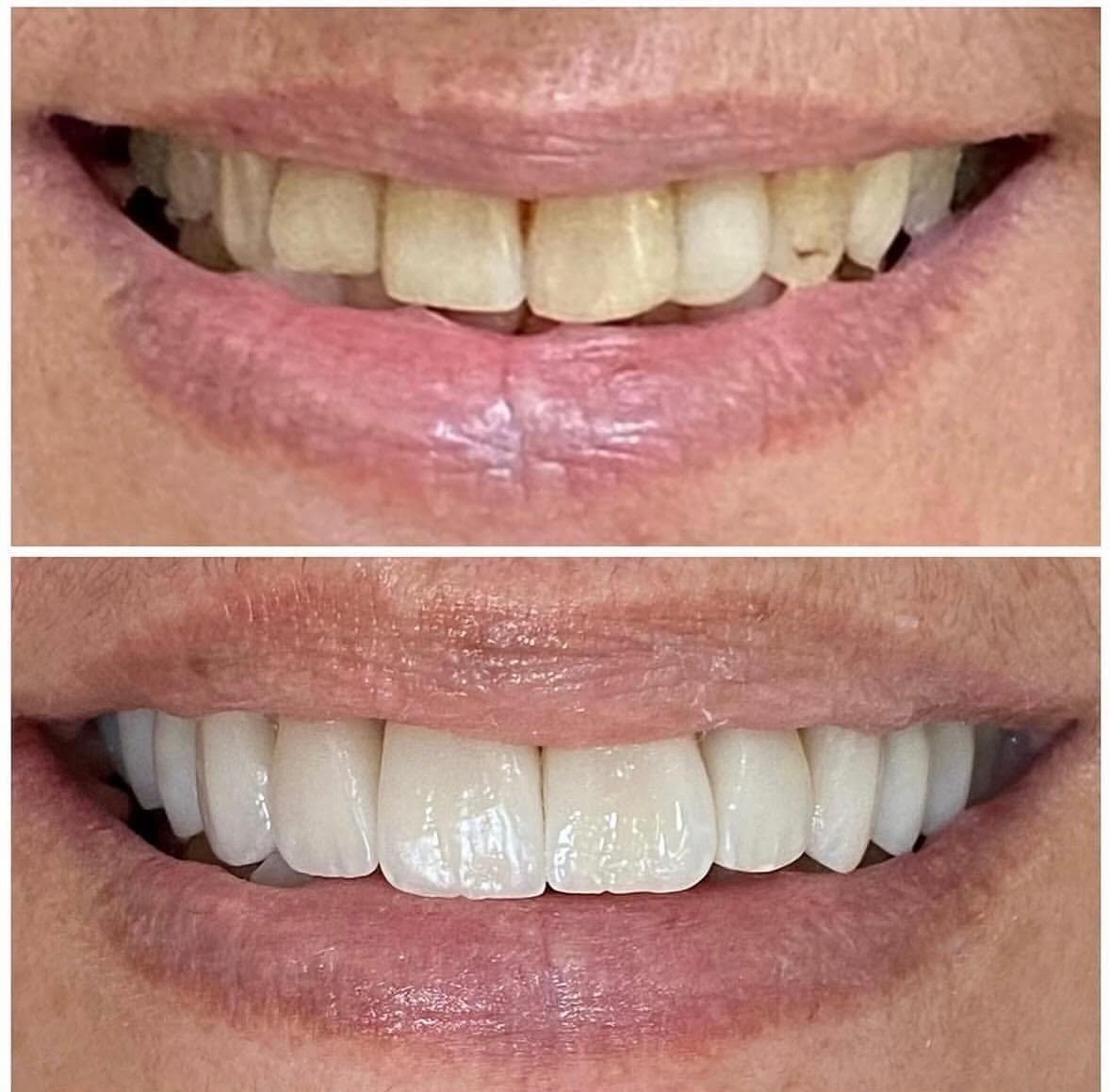 Transformação 6 — sorriso natural