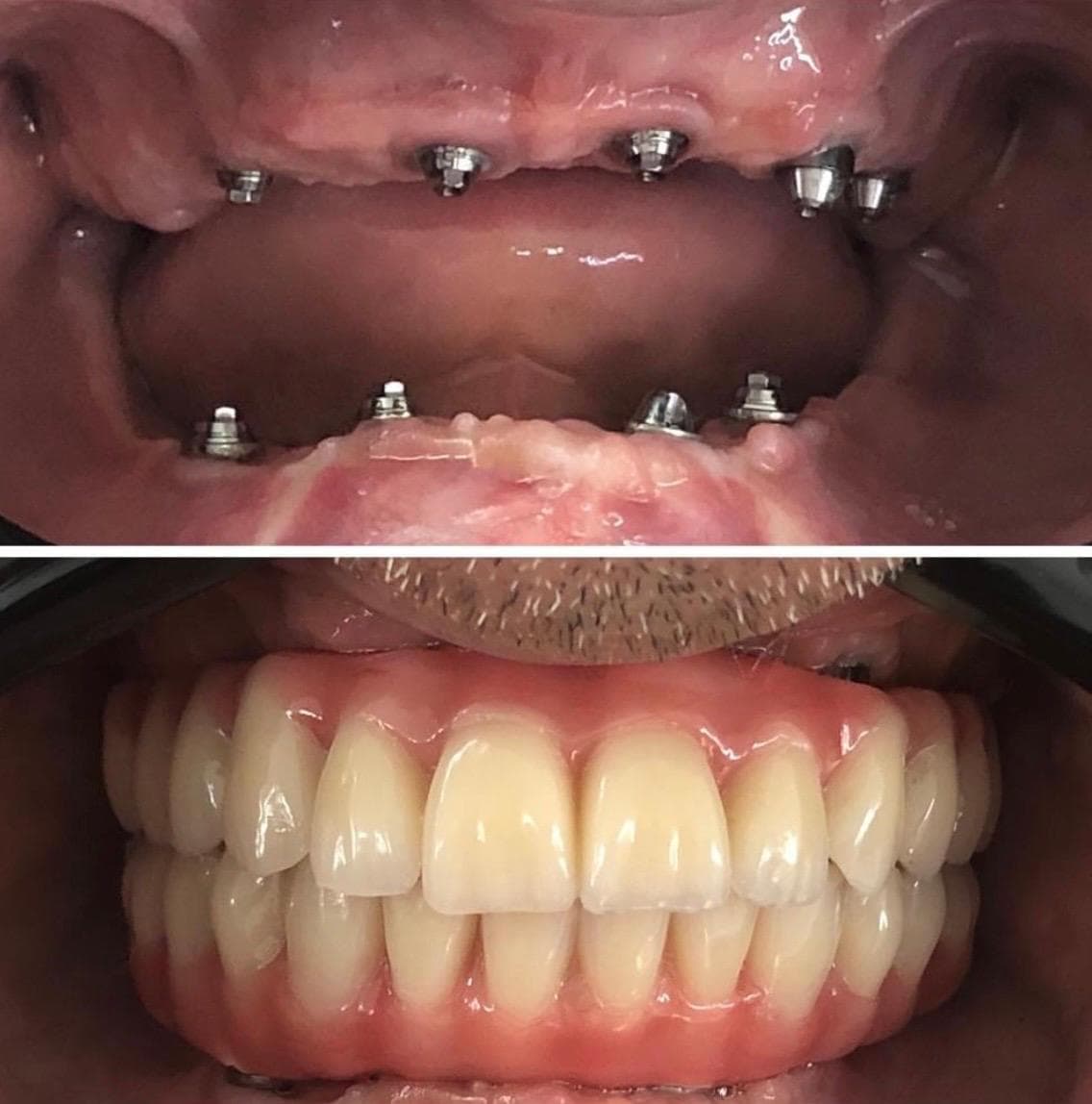 Transformação 1 — prótese dentária